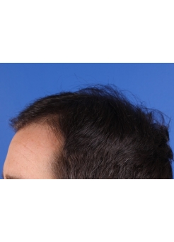 Before Hair Transplant&nbsp;Hairlines